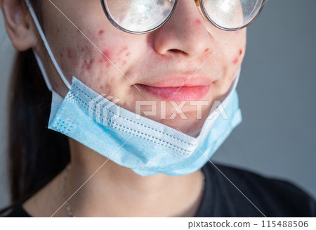 Close up of young Asian woman open her mask and showing acne problem occur on her skin caused of wearing mask for longtime. Close up of young Asian woman open her mask and showing acne problem occur on her skin caused of wearing mask for longtime. 115488506