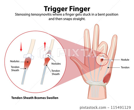 Trigger Finger Medical Illustration Trigger Finger Medical Illustration 115491129