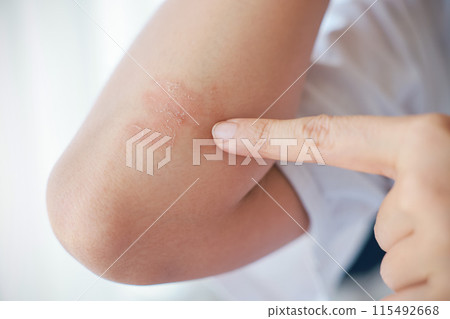 Close-up of skin Asian woman with acute psoriasis on her elbows. autoimmune incurable dermatological skin disease. A large red, inflamed, flaky rash on the elbows. skin by psoriatic arthritis. Close-up of skin Asian woman with acute psoriasis on her elbows. autoimmune incurable dermatological skin disease. A large red, inflamed, flaky rash on the elbows. skin by psoriatic arthritis. 115492668