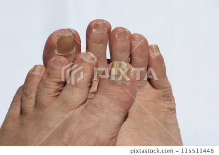 Toes with athlete's foot 115511448