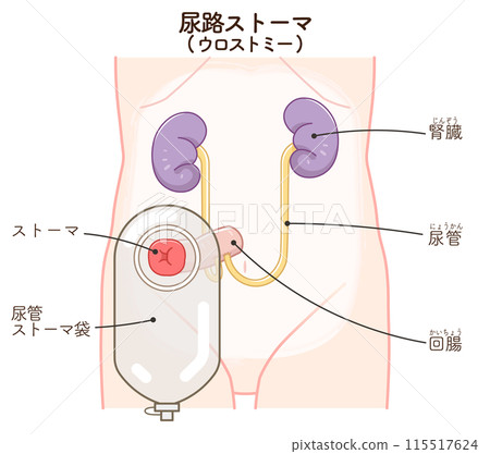 Urinary stoma, stoma, urostomy, ostomate, large intestine, small intestine, bladder, illustration Urinary stoma, stoma, urostomy, ostomate, large intestine, small intestine, bladder, illustration 115517624