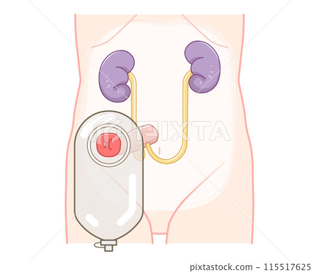 Urinary stoma, stoma, urostomy, ostomate, large intestine, small intestine, bladder, illustration Urinary stoma, stoma, urostomy, ostomate, large intestine, small intestine, bladder, illustration 115517625
