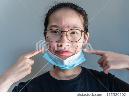 Young Asian woman open her mask and pointing acne problem occur on her skin caused of wearing mask for longtime. Young Asian woman open her mask and pointing acne problem occur on her skin caused of wearing mask for longtime. 115520302