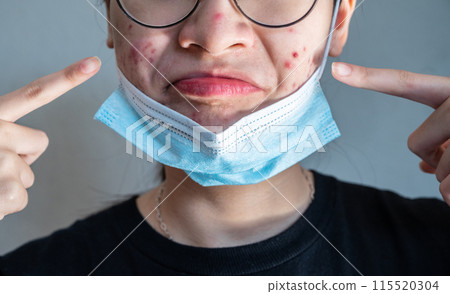 Cropped shot of Young Asian woman open her mask and pointing acne problem occur on her skin caused of wearing mask for longtime. 115520304