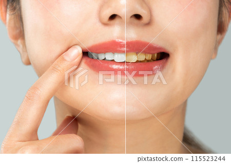 "Effects of whitening" A close-up relative comparison of yellowed teeth and white teeth. 115523244