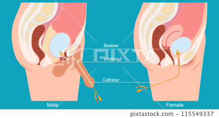 Urinary catheter in the male body and female body. 115549337