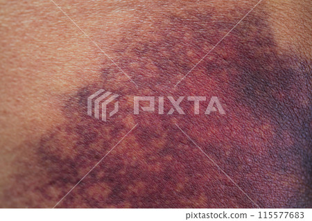 Asian woman dark bruise on the buttocks from a slip accident in the bathroom. Asian woman dark bruise on the buttocks from a slip accident in the bathroom. 115577683