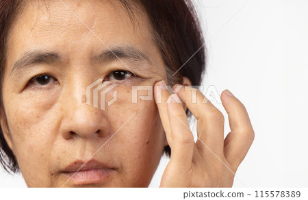 Flabby and wrinkled skin on senior woman face. 115578389