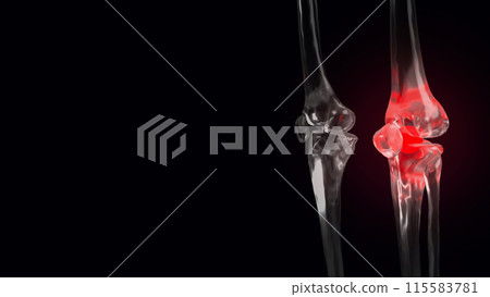 The Bone crystal for Osteoarthritis of the knee concept 3d rendering. The Bone crystal for Osteoarthritis of the knee concept 3d rendering. 115583781