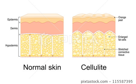 Cellulite formation. Orange peel syndrome Cellulite formation. Orange peel syndrome 115587395