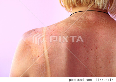 Traces of sunburn on the back of a woman. Female body Traces of sunburn on the back of a woman. Female body 115598417