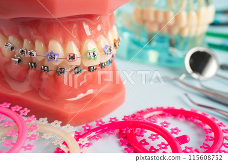 Orthodontic ligatures rings and ties, elastic rubber bands on orthodontic braces, model for dentist studying about dentistry. Orthodontic ligatures rings and ties, elastic rubber bands on orthodontic braces, model for dentist studying about dentistry. 115608752
