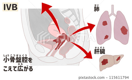 子宮頸癌IVB期(4B期) 簡單易懂的日文插圖 子宮頸癌IVB期(4B期) 簡單易懂的日文插圖 115611794