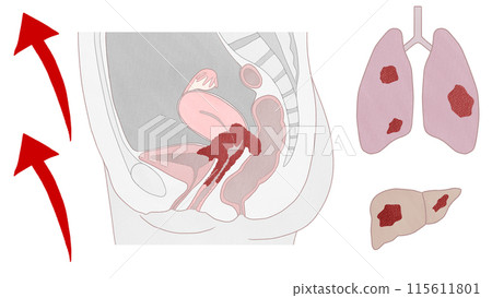 子宮頸癌IVB期(4B期) 簡單易懂的圖解 子宮頸癌IVB期(4B期) 簡單易懂的圖解 115611801