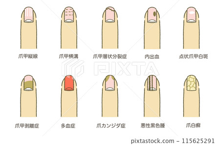 List of nail symptoms List of nail diseases Illustration material 115625291