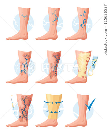 Stages or types of varicose veins development. Medical poster or disease infographic. Image of healthy and diseased legs. Vector illustration in flat style 115626557