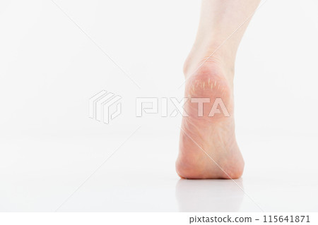 Cracked heels dry skin 115641871