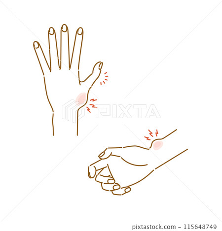 Menopausal symptoms in women: pain, swelling, and deformation of finger joints (thumb CM joint arthropathy, De Quervain's disease) 115648749