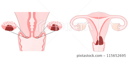 子宮頸癌1期（ⅠA・ⅠB） 簡單易懂的插圖 115652695