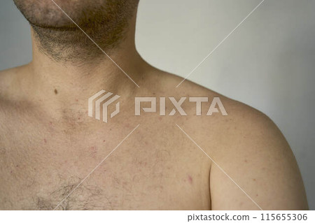 shoulder of a thirty-year-old man of medium build shoulder of a thirty-year-old man of medium build 115655306