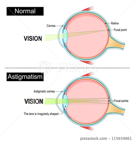 Astigmatism. Eye anatomy. 115659861