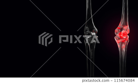 The Bone crystal for Osteoarthritis of the knee concept 3d rendering. The Bone crystal for Osteoarthritis of the knee concept 3d rendering. 115674084