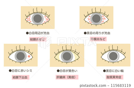 Eye abnormalities, eye diseases, eye symptoms illustrations Eye abnormalities, eye diseases, eye symptoms illustrations 115683119