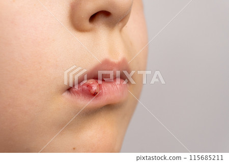 Skin damage, wound, abrasion on the lip of a small child. 115685211