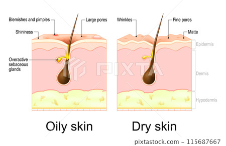 Oily and Dry skin. Skin types. Cross section of a human skin 115687667