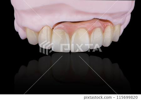 High-quality naturally dental single crowns made of zirconium for fixation to the frontal teeth of upper jaw. High-quality naturally dental single crowns made of zirconium for fixation to the frontal teeth of upper jaw. 115699820