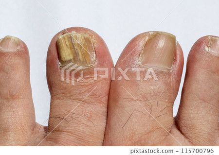 Discolored toenails 115700796