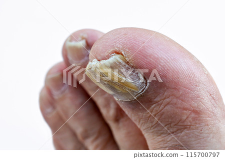 A worn out big toe nail A worn out big toe nail 115700797