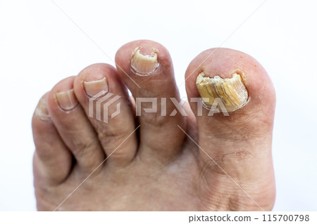 大腳趾甲變色 大腳趾甲變色 115700798