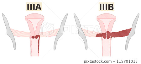 Cervical cancer stage 3 (IIIA/IIIB) Easy-to-understand illustration Cervical cancer stage 3 (IIIA/IIIB) Easy-to-understand illustration 115701015