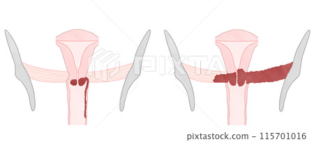 Cervical cancer stage 3 (IIIA/IIIB) Easy-to-understand illustration Cervical cancer stage 3 (IIIA/IIIB) Easy-to-understand illustration 115701016