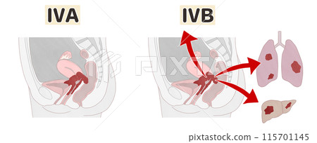 子宮頸癌第4期(IVA/IVB) 簡單易懂的插圖 子宮頸癌第4期(IVA/IVB) 簡單易懂的插圖 115701145
