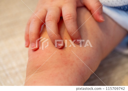 手足口病寶寶的手腳 手足口病寶寶的手腳 115709742