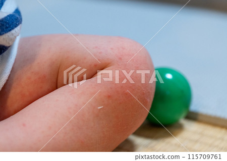 baby feet with hand foot and mouth disease baby feet with hand foot and mouth disease 115709761