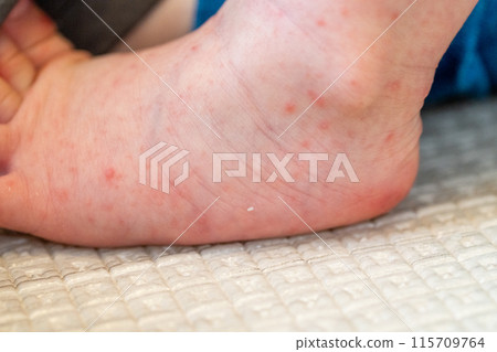 baby feet with hand foot and mouth disease baby feet with hand foot and mouth disease 115709764