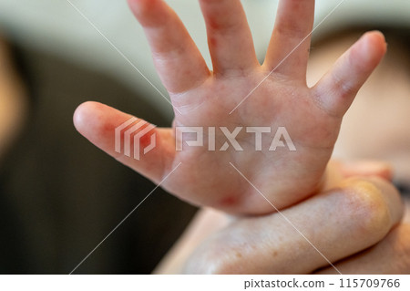 baby hand with hand foot and mouth disease baby hand with hand foot and mouth disease 115709766