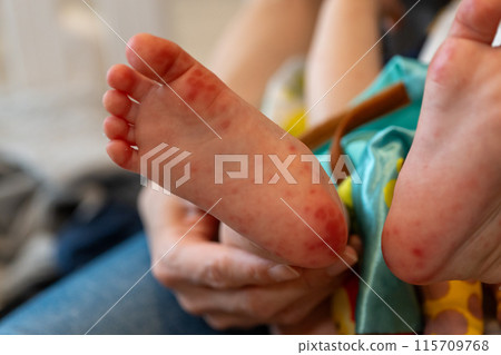 baby feet with hand foot and mouth disease baby feet with hand foot and mouth disease 115709768