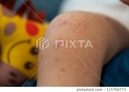 baby feet with hand foot and mouth disease 115709773