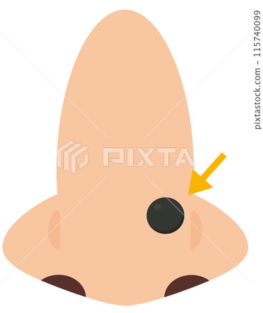 Mole on nose 115740099