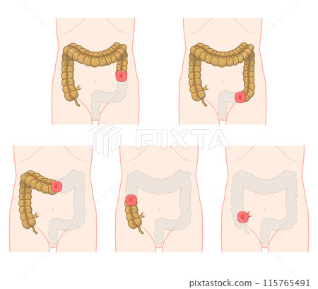 Colostomy, stoma, colon, illustration Colostomy, stoma, colon, illustration 115765491