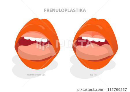 3D Isometric Flat Illustration of Frenuloplastika, Lip Tie Before and After Surgery 3D Isometric Flat Illustration of Frenuloplastika, Lip Tie Before and After Surgery 115769257