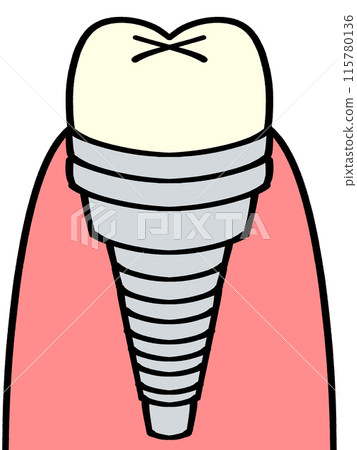 Simple implant tooth illustration material 115780136