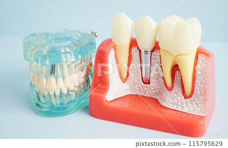 Dental implant, artificial tooth roots into jaw, root canal of dental treatment, gum disease, teeth model for dentist studying about dentistry. 115795629