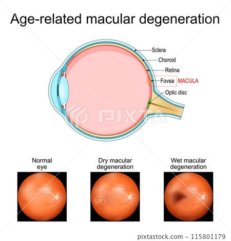 Age-related macular degeneration. Cross section of human eye 115801179