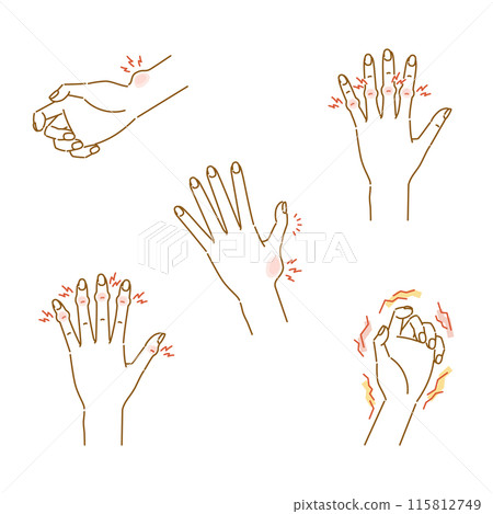 Menopausal disorder in women: illustration set of pain, swelling and deformation of finger joints 115812749