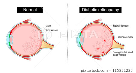 Diabetic retinopathy 115831223